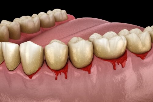 Illustrated mouth with bleeding gums