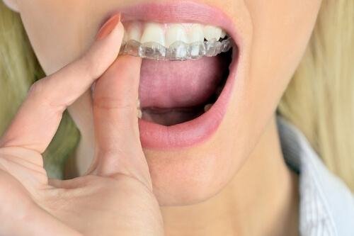 Close up of blonde woman placing a clear nightguard over her teeth