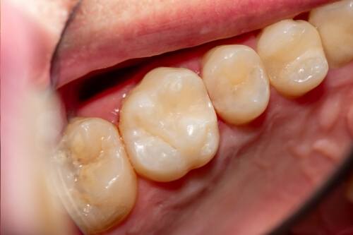 Close up of row of teeth with white fillings